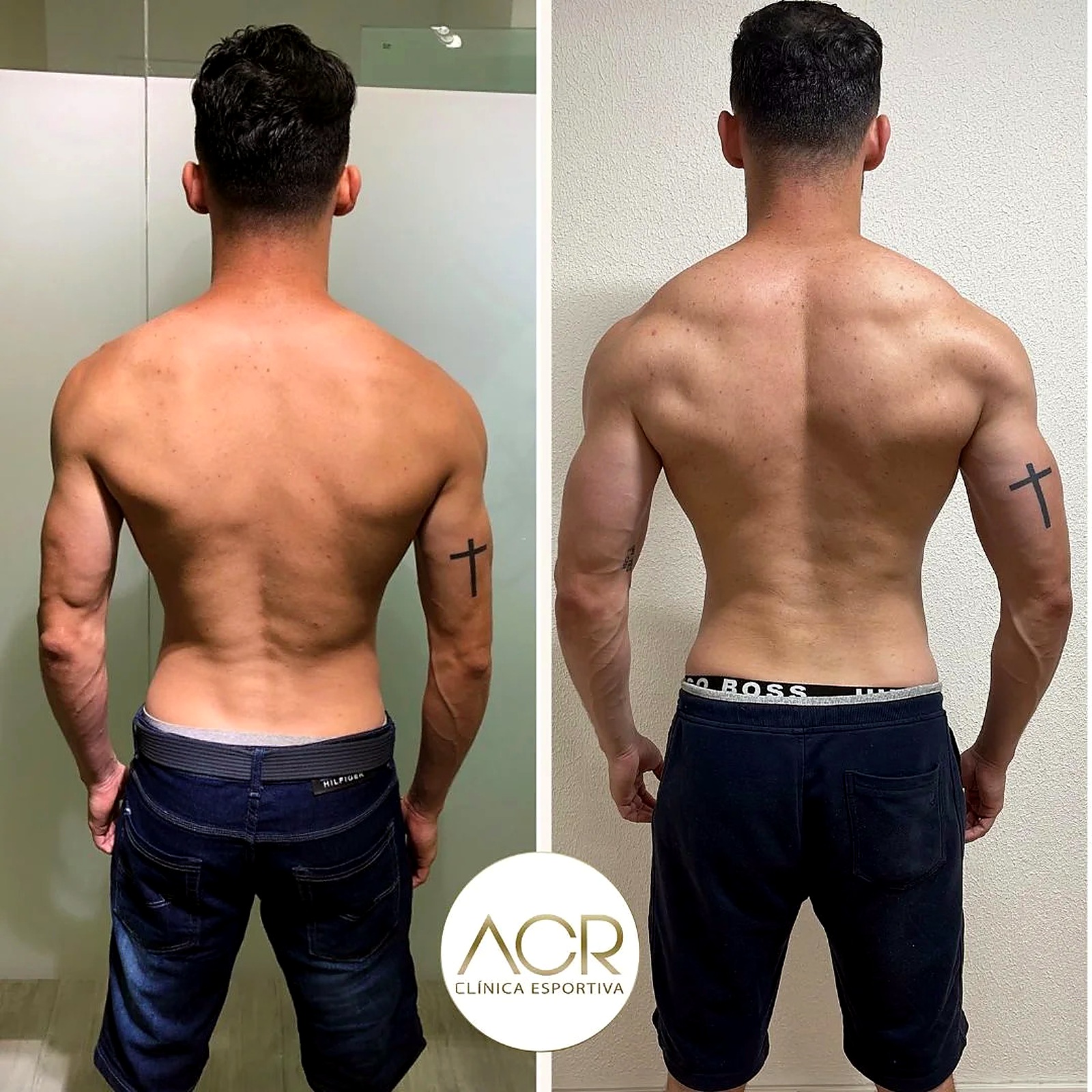 Resultado antes e depois 3 acompanhado pela ACR Clínica