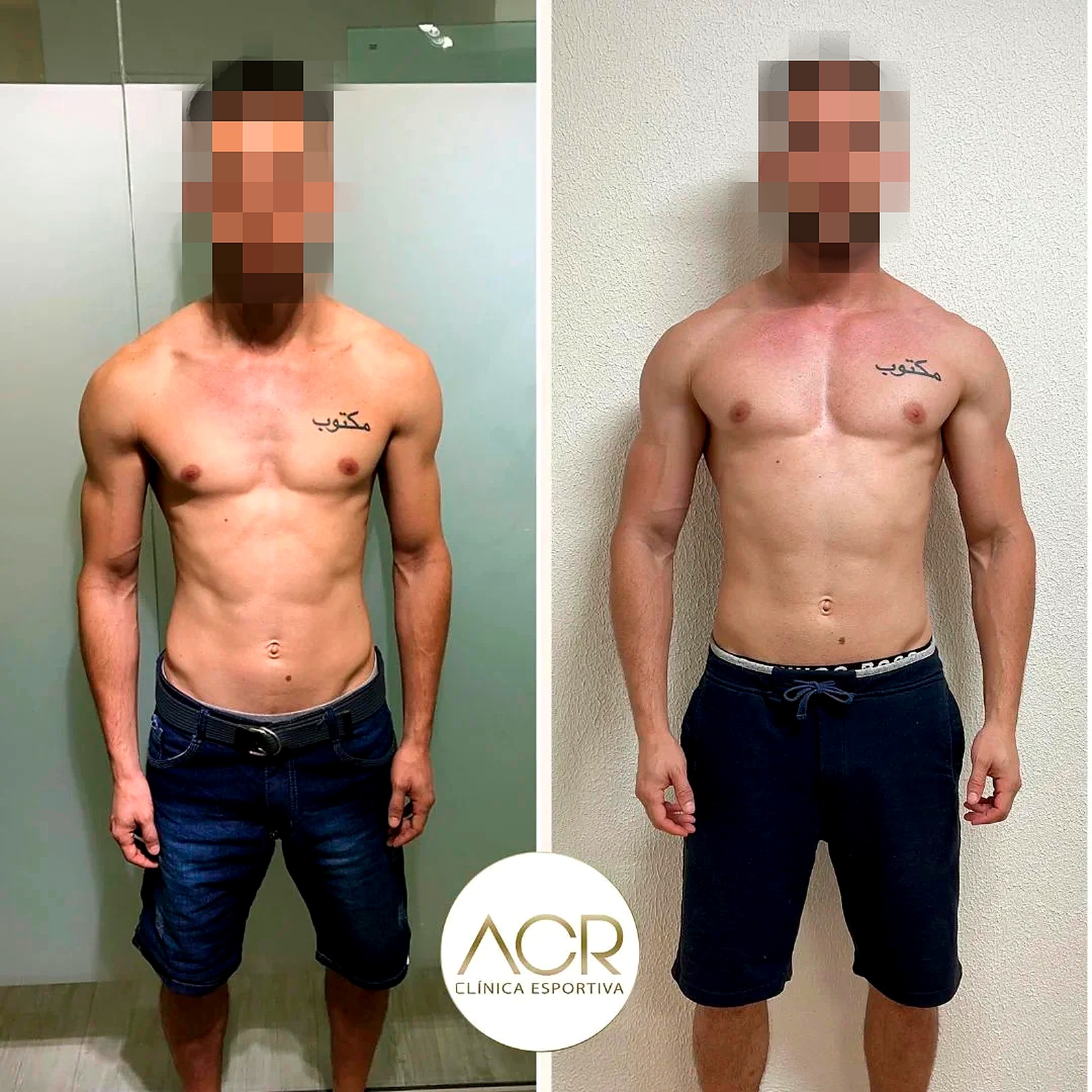 Resultado antes e depois 2 acompanhado pela ACR Clínica